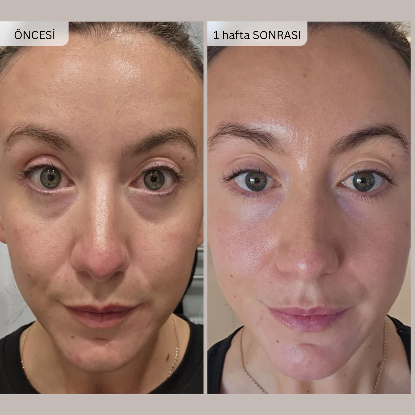 Micro İnfüzyon Dermal Bantlari