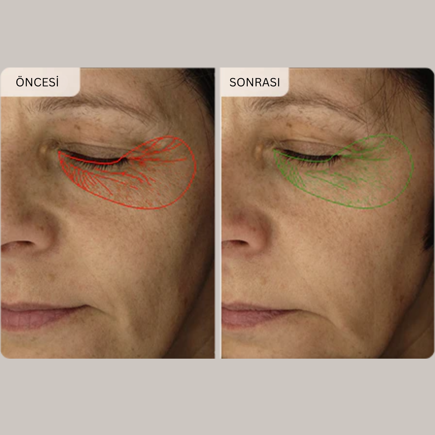 Micro İnfüzyon Dermal Bantlari